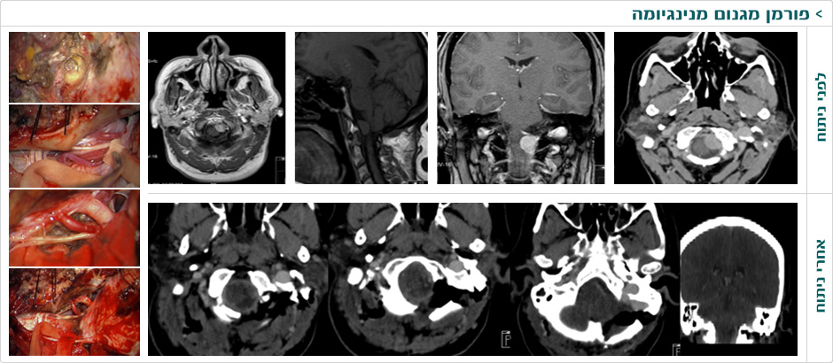 ד"ר משה עטיה, נוירוכירורג מומחה, מנתח מוח